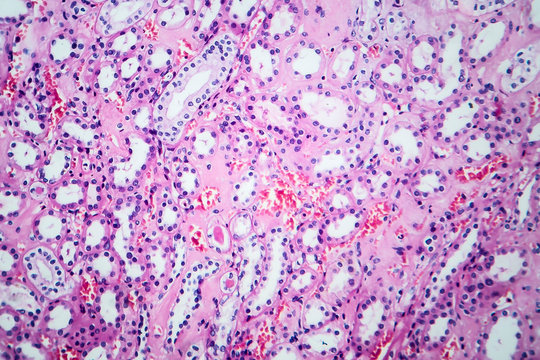 Histopathology of hypertensive renal disease, light micrograph, photo under microscope