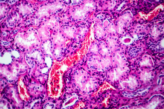 Histopathology of hypertensive renal disease, light micrograph, photo under microscope