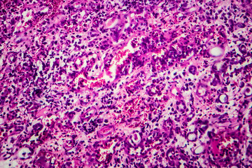 Histopathology of interstitial nephritis, light micrograph, photo under microscope