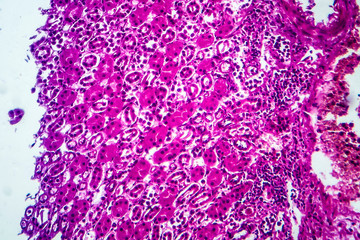 Histopathology of acute nephritis, light micrograph, photo under microscope