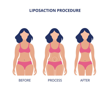 Liposuction procedure before and after banner flat vector illustration isolated.