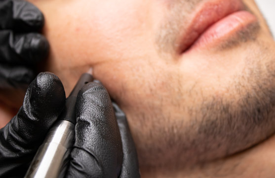 Male trichopigmentation service. Young man laying on the back on the esthetician table. Master hands in a black gloves holding the permanent makeup machine with the needle and touching mans hair.