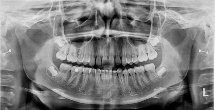 Zahnr&ouml;ntgen im Detail, OPG-Aufnahme des Gebisses mit Retainer und Weisheitsz&auml;hnen