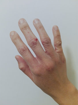 The back of female hand gets dried, cracked, reddened, itchy, flaking and bleeding in winter on white background. Eczema, Dermatitis on the back of hard working and wrinkles female hand.