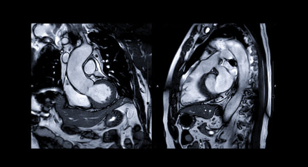 MRI heart or Cardiac MRI ( magnetic resonance imaging ) of heart compare RVOT and LVOT for diagnosis heart disease. - obrazy, fototapety, plakaty