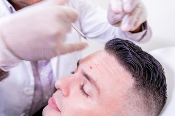 Obraz na płótnie Canvas Caucasian man undergoing beauty spa botulinum neurotoxin Botox treatment for anti-aging, to smooth wrinkles as a cometic solution. Injecting forehead to relax muscles with a non-invasive procedure.