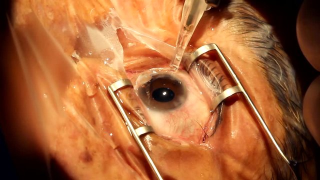 phacomulsification iol cataract eye surgery