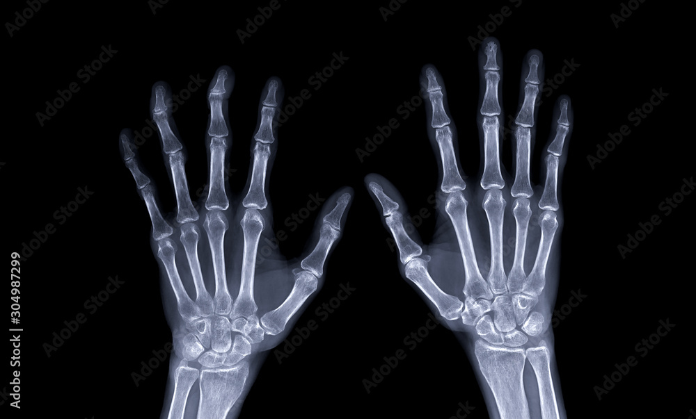 Poster xray image of both hand ap view isolated on black background for diagnostic rheumatoid.