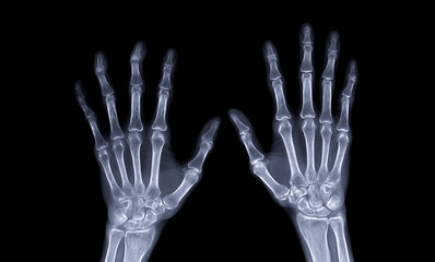 xray image of both hand AP view isolated on black  background  for diagnostic rheumatoid.