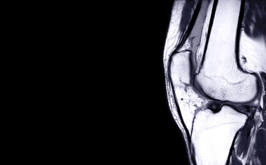 Compare of MRI Knee joint or Magnetic resonance imaging  sagital view for detect tear or sprain of...