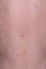 Chickenpox pimples on skin