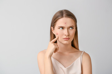 Portrait of young woman with acne problem on light background