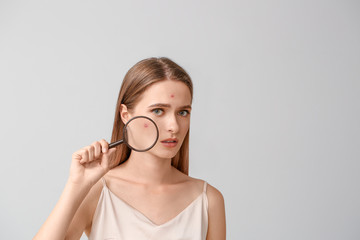 Portrait of young woman with acne problem and magnifier on light background