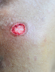 Inflammation of the skin lesions