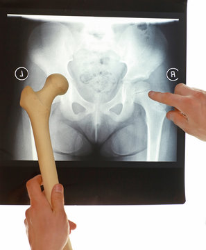 Specialist with femur bone model watching image of pelvis at x-ray film viewer,. Diagnosis,treatment planning