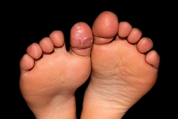 Atopic dermatitis, eczema. Close up of eczema on the skin of the kid's foot