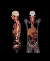 PET CT Scan fusion image