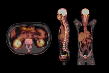 PET CT Scan fusion image