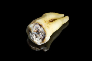 Kaputter Zahn, kariös mit Füllung auf schwarzem spiegelndem Untergrund