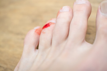 blood on the toe of a man's foot close-up. concept of health and hygiene