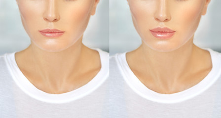 Beauty injections.Concept of rejuvenation.Lip augmentation	