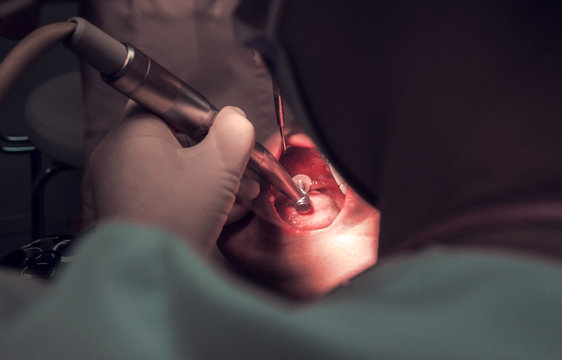 tdentistry. dental treatment, close-up. teeth and caries.