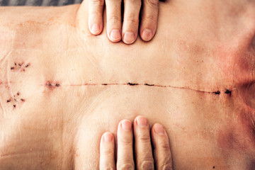 Scar from open heart surgery on the female body, where the sternum was cut in two, and the rib cage sprung. Image taken 30 days (1 month) following surgery.
