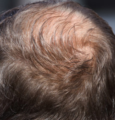 Male pattern baldness. Increased testosterone disease