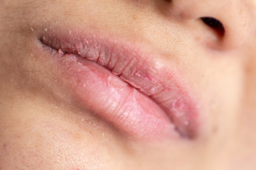 Fototapeta premium Backgrounds of Dry lips in the clinic.