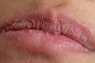 Backgrounds of Dry lips in the clinic.