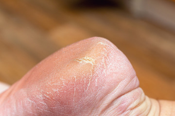 Corn callus cracks on a sole heel foot close up. Dry skin dermatology problem.