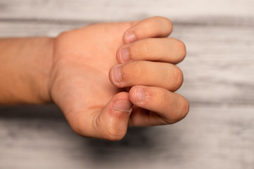 Teenager's hand with ugly nails. Biting fingernails