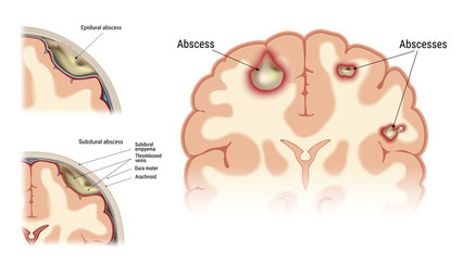Abscess of the human brain. Visual image of the location of the focus of infectious inflammation.