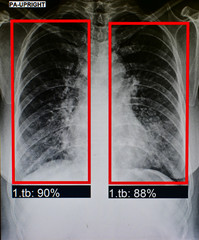 flim x-ray patient's lung . has been AI diagnosed tuberculosis