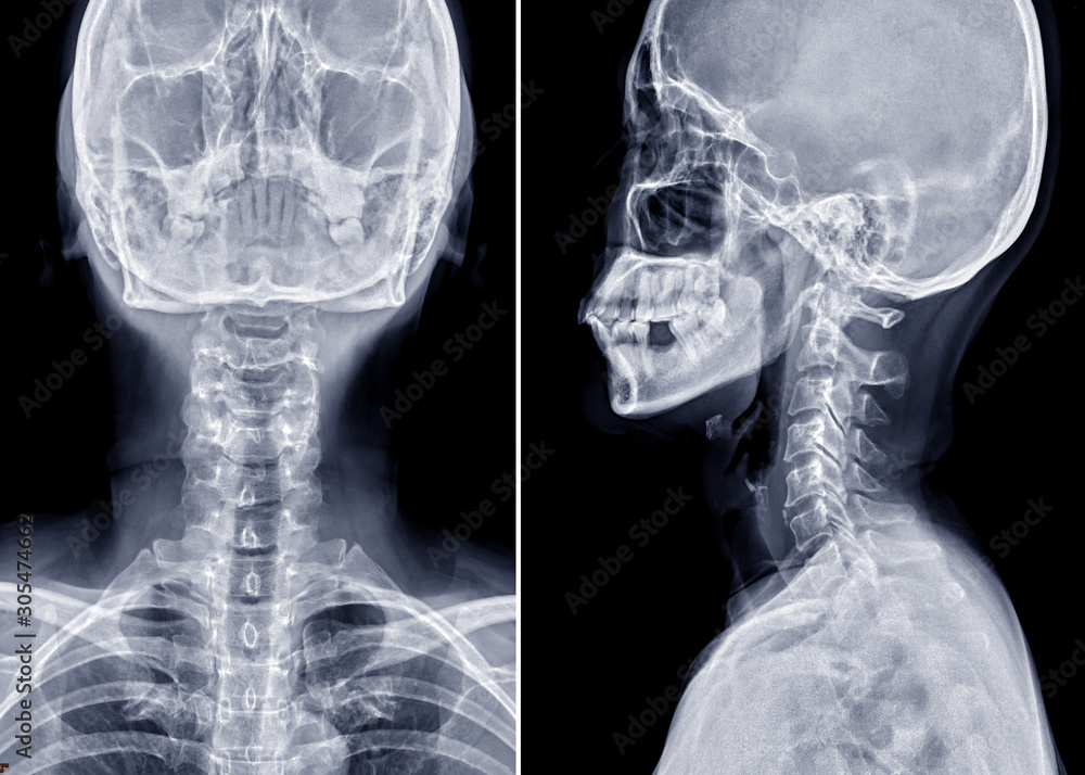 Poster x-ray c-spine or x-ray image of cervical spine ap and lateral view for diagnostic intervertebral dis