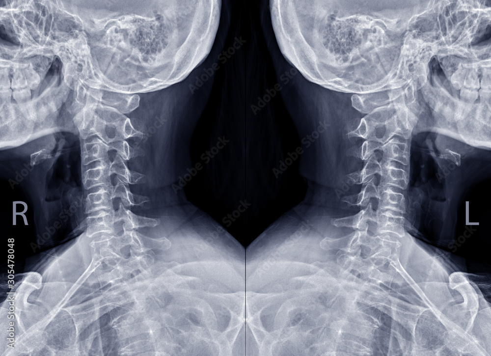 Poster collection of x-ray c-spine or x-ray image of cervical spine oblique view both side for diagnostic i
