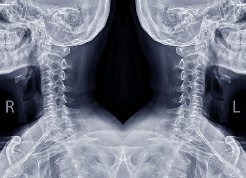 Collection of X-ray C-spine or x-ray image of Cervical spine oblique view both side for diagnostic intervertebral disc herniation..