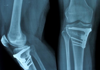 osteotomy