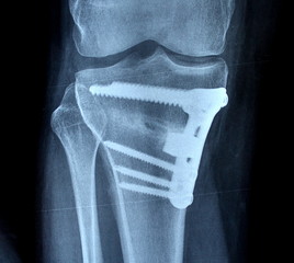 osteotomy