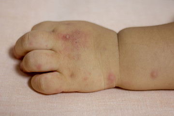 Fototapeta premium Hand Foot and Mouth disease