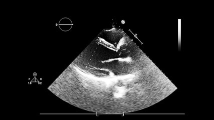 Screen of an ultrasound machine with a heart image.