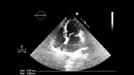 Screen of an ultrasound machine with a heart image.
