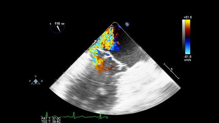 Screen of an ultrasound machine with a heart image.