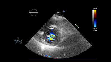 Screen of an ultrasound machine with a heart image.