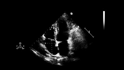 Fototapeta na wymiar Screen of an ultrasound machine with a heart image.
