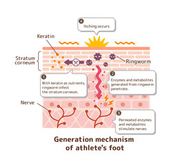 Generation mechanisim of athlete's foot ( ringworm) vector illustration / with English explanation texts.