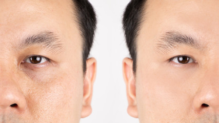 Close up of middle aged Asian man face with wrinkles, sun damage, dark circles under the eyes, before and after procedures.