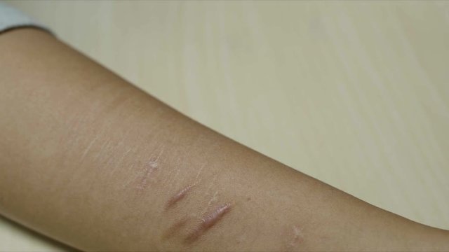 Scars on the wrist of a person who tried to commit suicide by slicing veins in wrist due to depression, anxiety and sadness