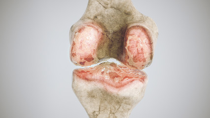 Advanced osteoarthritis - stage 3 - on the knee joint - high degree of detail - 3D Rendering