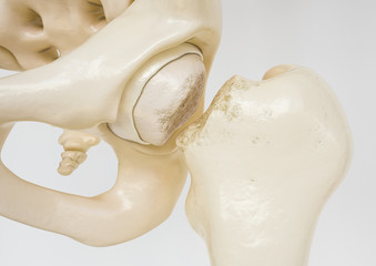 Femoral neck fracture - 3D Rendering